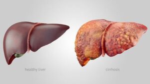 10 - Liver Cirrhosis