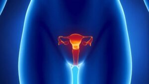 31 - Fibroids