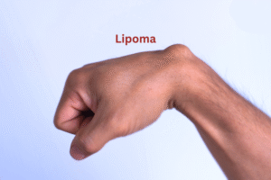 49 - Lipoma