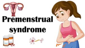 58 - Premenstrual Syndrome