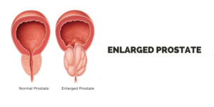 60 - Enlarged Prostate
