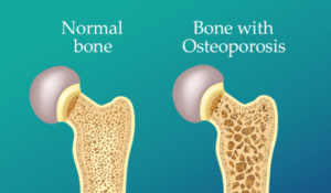 61 - Osteoporosis