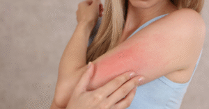 64 - Itching Treatment